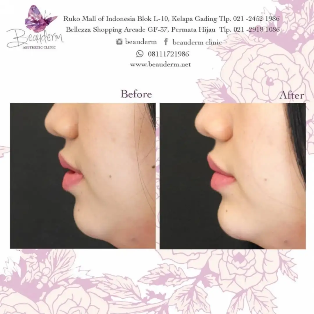 Chin Augmentation / Filler Dagu
